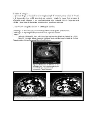 Estudios de Imagen:
La presencia de gas se puede observar en una placa simple de abdomen, pero el estudio de elección
es la tomografía, si es posible con medio de contraste y simple. Se puede observar datos de
inflamación renal, así como el gas en el parénquima renal o sistema colector, la presencia de
cálculos y otros datos de obstrucción, así mismo sirve para buscar abscesos.
La clasificación tomográfica descrita en la bibliografía reporta:
Clase 1: gas en elsistema colector solamente (también llamada pielitis enfisematosa).
Clase 2: gas en elparénquima renal sin extensión al espacio extrarrenal.
Clase 3:
Clase 3A extensión del gas o absceso alespacio perirrenal (Dentro de la Fascia de Gerota).
Clase 3B: extensión del gas o absceso al espacio pararrenal(Fuera de la Fascia de Gerota).
Clase 4: pielonefritis enfisematosa bilateral o riñón único
 