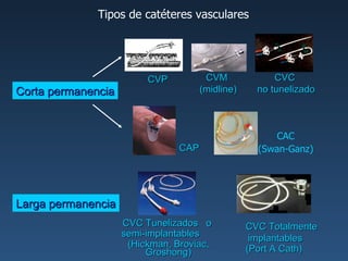 Corta permanencia CVP CVC  no tunelizado CVM  (midline) CAC (Swan-Ganz) CAP Larga permanencia CVC Tunelizados  o  semi-implantables  (Hickman, Broviac, Groshong) CVC Totalmente  implantables ( Port A Cath ) Tipos de catéteres vasculares 