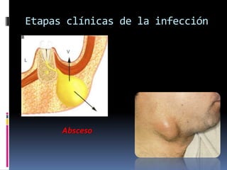 Etapas clínicas de la infección
Absceso
 