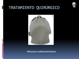 TRATAMIENTO QUIRÚRGICO
Abscesos submentonianos
 
