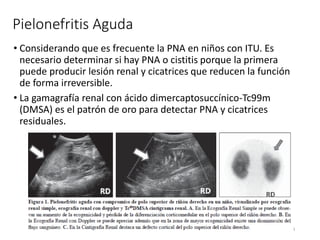 Pielonefritis Aguda
• Considerando que es frecuente la PNA en niños con ITU. Es
necesario determinar si hay PNA o cistitis porque la primera
puede producir lesión renal y cicatrices que reducen la función
de forma irreversible.
• La gamagrafía renal con ácido dimercaptosuccínico-Tc99m
(DMSA) es el patrón de oro para detectar PNA y cicatrices
residuales.
26
 
