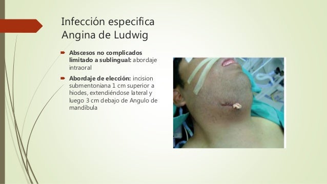 Lobulo Infectado Infeccion de espacios profundos cuello