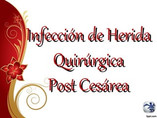 Infección de Herida
Quirúrgica
Post Cesárea

 