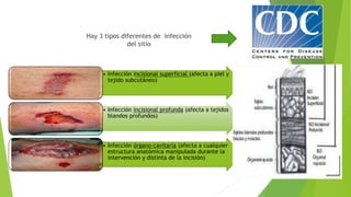 Hay 3 tipos diferentes de infección
del sitio
• Infección incisional superficial (afecta a piel y
tejido subcutáneo)
• Infección incisional profunda (afecta a tejidos
blandos profundos)
• Infección órgano-cavitaria (afecta a cualquier
estructura anatómica manipulada durante la
intervención y distinta de la incisión)
 