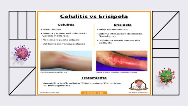 Linfangitis Reticular Infeccion de tejidos blandos, Celulitis, Erisipela y Linfangitis ...