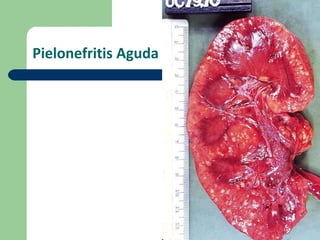 Pielonefritis Aguda 