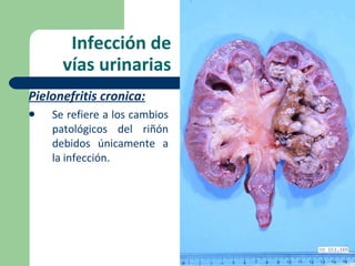 Infección de vías urinarias Pielonefritis cronica: Se refiere a los cambios patológicos del riñón debidos únicamente a la infección.  