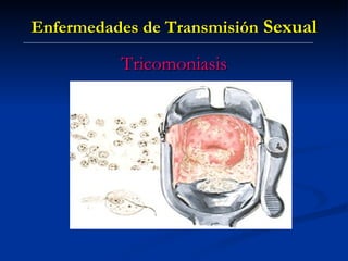 Enfermedades de Transmisión  Sexual Tricomoniasis 