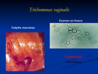 Trichomonas vaginalis  Examen en fresco Colpitis maculosa Tratamiento. Metronidazol 