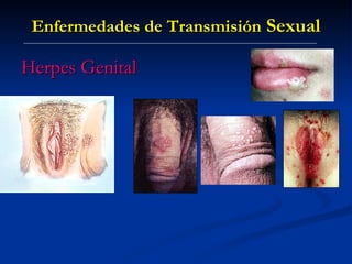 Enfermedades de Transmisión  Sexual Herpes Genital 