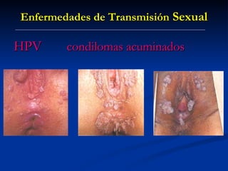 Enfermedades de Transmisión  Sexual HPV   condilomas acuminados 