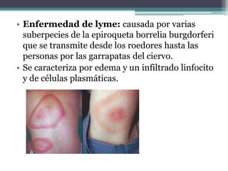 • Enfermedad de lyme: causada por varias
suberpecies de la epiroqueta borrelia burgdorferi
que se transmite desde los roedores hasta las
personas por las garrapatas del ciervo.
• Se caracteriza por edema y un infiltrado linfocito
y de células plasmáticas.
 