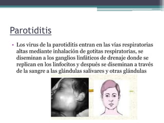 Parotiditis
• Los virus de la parotiditis entran en las vías respiratorias
altas mediante inhalación de gotitas respiratorias, se
diseminan a los ganglios linfáticos de drenaje donde se
replican en los linfocitos y después se diseminan a través
de la sangre a las glándulas salivares y otras glándulas
 