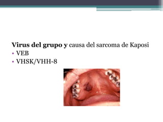 Virus del grupo y causa del sarcoma de Kaposi
• VEB
• VHSK/VHH-8
 