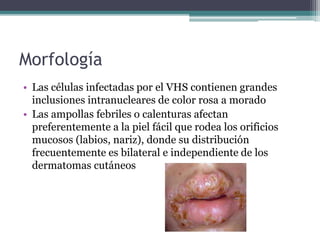 Morfología
• Las células infectadas por el VHS contienen grandes
inclusiones intranucleares de color rosa a morado
• Las ampollas febriles o calenturas afectan
preferentemente a la piel fácil que rodea los orificios
mucosos (labios, nariz), donde su distribución
frecuentemente es bilateral e independiente de los
dermatomas cutáneos
 