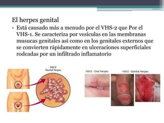 El herpes genital
• Está causado más a menudo por el VHS-2 que Por el
VHS-1. Se caracteriza por vesículas en las membranas
musucas genitales así como en los genitales externos que
se convierten rápidamente en ulceraciones superficiales
rodeadas por un infiltrado inflamatorio
 