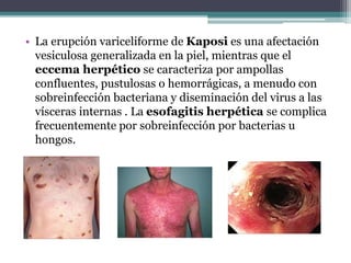 • La erupción variceliforme de Kaposi es una afectación
vesiculosa generalizada en la piel, mientras que el
eccema herpético se caracteriza por ampollas
confluentes, pustulosas o hemorrágicas, a menudo con
sobreinfección bacteriana y diseminación del virus a las
vísceras internas . La esofagitis herpética se complica
frecuentemente por sobreinfección por bacterias u
hongos.
 