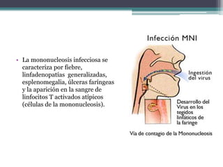 • La mononucleosis infecciosa se
caracteriza por fiebre,
linfadenopatías generalizadas,
esplenomegalia, úlceras faríngeas
y la aparición en la sangre de
linfocitos T activados atípicos
(células de la mononucleosis).
 