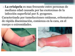 oLa erisipela es mas frecuente entre personas de
mediana edad causada por las exotoxinas de la
infección superficial por S. pyogenes.
Caracterizada por tumefacciones cutáneas, eritematosa
de rápida diseminación, comienza en la cara, en el
cuerpo o extremidades.
 