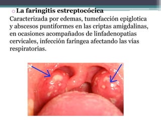 oLa faringitis estreptocócica
Caracterizada por edemas, tumefacción epiglotica
y abscesos puntiformes en las criptas amigdalinas,
en ocasiones acompañados de linfadenopatias
cervicales, infección faríngea afectando las vías
respiratorias.
 