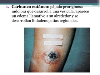 1. Carbunco cutáneo: pápula pruriginosa
indolora que desarrolla una vesícula, aparece
un edema llamativo a su alrededor y se
desarrollan linfadenopatias regionales.
 