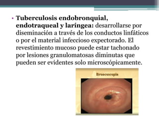 • Tuberculosis endobronquial,
endotraqueal y laríngea: desarrollarse por
diseminación a través de los conductos linfáticos
o por el material infeccioso expectorado. El
revestimiento mucoso puede estar tachonado
por lesiones granulomatosas diminutas que
pueden ser evidentes solo microscópicamente.
 