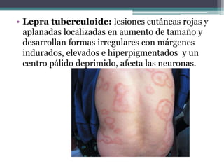 • Lepra tuberculoide: lesiones cutáneas rojas y
aplanadas localizadas en aumento de tamaño y
desarrollan formas irregulares con márgenes
indurados, elevados e hiperpigmentados y un
centro pálido deprimido, afecta las neuronas.
 