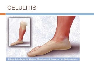CELULITIS
 