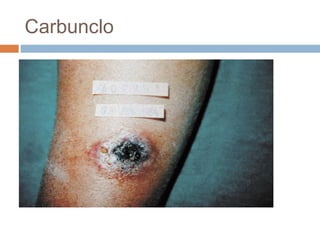 Carbunclo
 