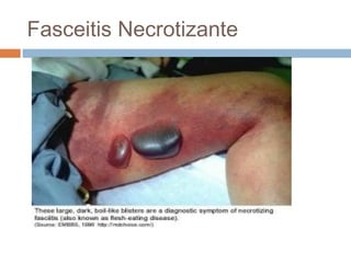 Fasceitis Necrotizante
 
