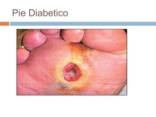 Pie Diabetico
 