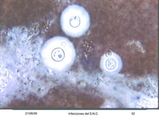 MENINGITIS BACTERIANA 