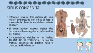 SIFILIS CONGENITA
• Infección severa, transmitida de una
mujer embarazada con sífilis al feto a
través de la placenta en el desarrollo o
al nacer
• El bebe puede mostrar signos de:
hepato esplenomegalia e inflamación
del hueso
• Caracteristicas visibles en el bebe:
TRIADA DE HUTCHINSON, periostitis
frontal, ausencia de puente nasa y
dientes de Hutchinson
 