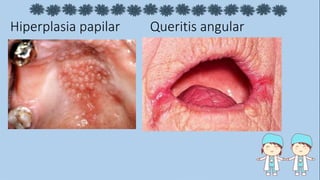 Hiperplasia papilar Queritis angular
 