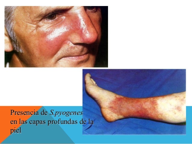 Las manchas en la piel de pigmento vascular