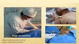 NNIS. Am J Infect Control 2004; 32: 470–85
Lorente L. Critical Care 2005, 9:631-635
Elegir vía subclavia
 