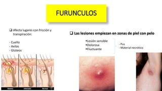 FURUNCULOS
 Afecta lugares con fricción y
transpiración:
- Cuello
- Axilas
- Glúteos
 Las lesiones empiezan en zonas de piel con pelo
Lesión sensible
Dolorosa
Fluctuante
- Pus
- Material necrótico
 