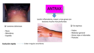 ANTRAX
Lesión inflamatoria, mayor y mas grave con
lesiones mucho mas profundas
 Lesiones dolorosas
- Nuca
- Miembros
- Espalda
 Se expresa:
- Fiebre
- Malestar general
- Zonas rojas e induradas
- Pústulas
Evolución rápida Cráter irregular amarillento
 