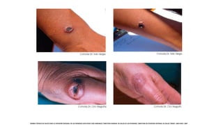 NORMA TÉCNICA DE SALUD PARA LA ATENCIÓN INTEGRAL DE LAS PERSONAS AFECTADAS CON CARBUNCO. DIRECCION GENERAL DE SALUD DE LAS PERSONAS. DIRECCION DE ATENCION INTEGRAL DE SALUD. MINSA. LIMA-PERU. 2007.
 