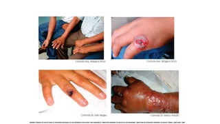 NORMA TÉCNICA DE SALUD PARA LA ATENCIÓN INTEGRAL DE LAS PERSONAS AFECTADAS CON CARBUNCO. DIRECCION GENERAL DE SALUD DE LAS PERSONAS. DIRECCION DE ATENCION INTEGRAL DE SALUD. MINSA. LIMA-PERU. 2007.
 