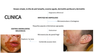 CLINICA IMPETIGO NO AMPOLLOSO
Microvesiculoso o Contagioso
Pequeñas papulas eritematosas agrupadas
Microvesiculas de pared frágil
Contenido acuoso claro
Evolucionan
Ruptura / se seca
COSTRAS AMARILLENTAS
MELICERICAS
Herpes simple, la tiña de piel lampiña, eczema agudo, dermatitis peribucal y dermatitis
Diagnostico diferencial
 