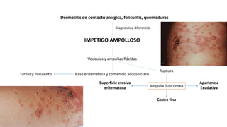 IMPETIGO AMPOLLOSO
Vesículas y ampollas flácidas
Base eritematosa y contenido acuoso claroTurbio y Purulento
Ruptura
Ampolla Subcórnea
Superficie erosiva
eritematosa
Apariencia
Exudativa
Costra fina
Dermatitis de contacto alérgica, foliculitis, quemaduras
Diagnostico diferencial
 