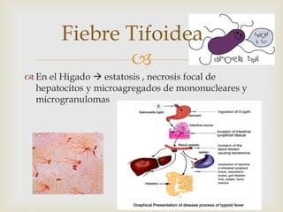 Tuberculosis 
 
 La infeccion hepatica 
 Via hematogenea y produce granulomas caseosos 
con celulas gigantes tipo langh...