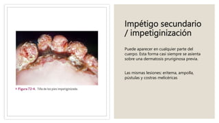 Impétigo secundario
/ impetiginización
Puede aparecer en cualquier parte del
cuerpo. Esta forma casi siempre se asienta
sobre una dermatosis pruriginosa previa.
Las mismas lesiones: eritema, ampolla,
pústulas y costras melicéricas
 