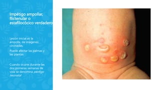 Impétigo ampollar,
flictenular o
estafilocócico verdadero
Lesión inicial es la
ampolla, da imágenes
circinadas.
Puede afectar las palmas y
las plantas
Cuando ocurre durante las
dos primeras semanas de
vida se denomina pénfigo
neonatal
 