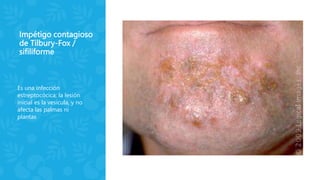 Impétigo contagioso
de Tilbury-Fox /
sifiliforme
Es una infección
estreptocócica; la lesión
inicial es la vesícula, y no
afecta las palmas ni
plantas
 