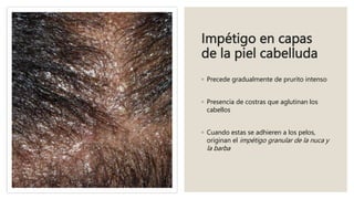 Impétigo en capas
de la piel cabelluda
◦ Precede gradualmente de prurito intenso
◦ Presencia de costras que aglutinan los
cabellos
◦ Cuando estas se adhieren a los pelos,
originan el impétigo granular de la nuca y
la barba
 