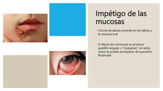 Impétigo de las
mucosas
◦ Consta de placas erosivas en los labios y
la mucosa oral
◦ Si afecta las comisuras se produce
queilitis angular o “boqueras”; en estos
casos se puede acompañar de queratitis
flictenular
 