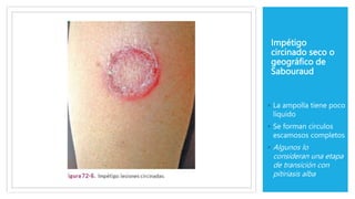 Impétigo
circinado seco o
geográfico de
Sabouraud
◦ La ampolla tiene poco
líquido
◦ Se forman círculos
escamosos completos
◦ Algunos lo
consideran una etapa
de transición con
pitiriasis alba
 