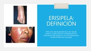 ERISIPELA:
DEFINICIÓN
Infección dermoepidérmica de rápido
avance, producida por estreptococo β-
hemolítico del grupo A con una afectación
linfática dérmica marcada.
 